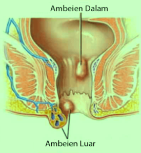 6 Obat Tradisional Yang Ampuh Mengobati Ambeien