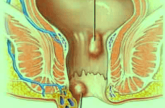 6 Obat Tradisional Yang Ampuh Mengobati Ambeien