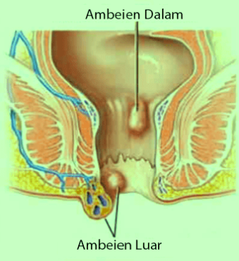 6 Obat Tradisional Yang Ampuh Mengobati Ambeien