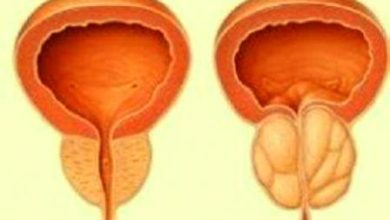 Cara Mencegah Kanker Prostat Secara Alami
